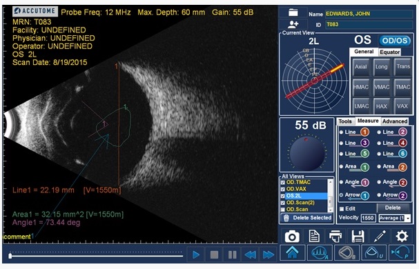 B- Scan