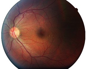 fundus picture