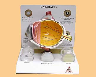 Catarat Eye Model